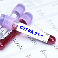 Анализ крови на онкомаркер cyfra 21-1