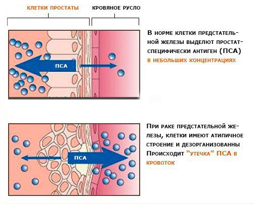 Повышение концентрации ПСА Повышение количества клеток ПСА в крови
