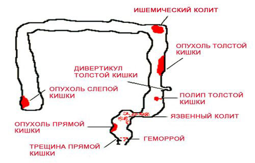 Когда сдают кал на скрытую кровь При каких заболеваниях в кале может появиться скрытая кровь