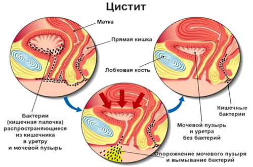 Бактерии в уретре и мочевом пузыре Как попадают бактерии в мочевой пузырь при цистите