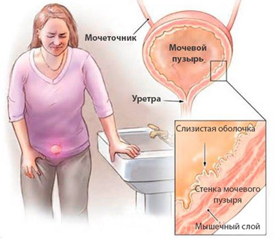 Что покажет анализ мочи при цистите Восспаление слизистой оболочки мочевого пузыря у женщины