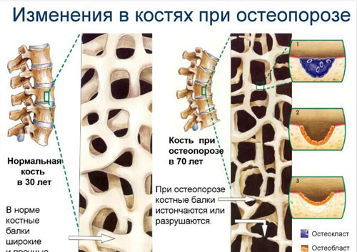 Показания к анализу на остеопороз Обследование на остеопороз - какие анализы сдают