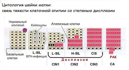 акие клетки можно считать атипичными Как возникают и чем опасны атипичные клетки шейки матки