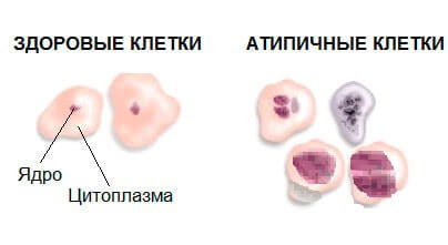 Атипичные клетки в мазке Что такое и чем опасны атипичные клетки