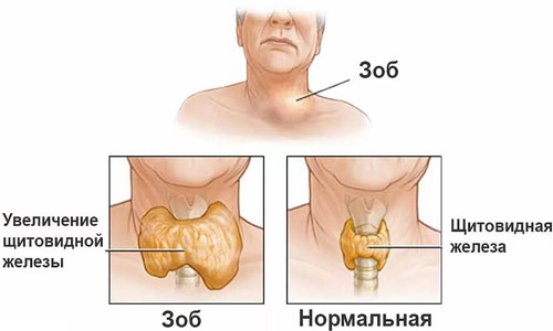 Диффузный токсический зоб Что происходит в организме, если повышен Т3 свободный