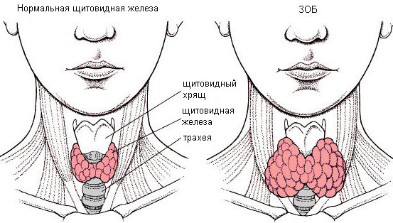Зоб щитовидной железы Зачем проводится анализ на тиреоглобулин (Tg)?