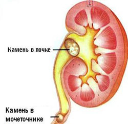 Локализация камней в почке Камень в почке и мочеточнике