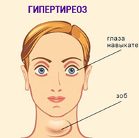 Гипертиреоз щитовидной железы