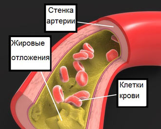 жировые отложения плохого холестирина на стенках сосуда жировые отложения плохого холестирина на стенках сосуда