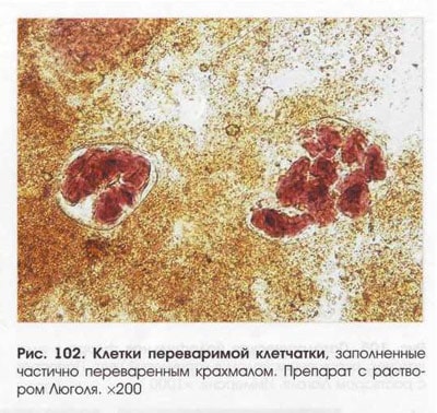 Крахмал в кале - амилорея Крахмал в кале у ребенка и у взрослого (амилорея)