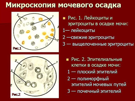 Эритроциты и эпителий в осадке мочи В норме эритроциты в осадке мочи отсутствуют или единичные