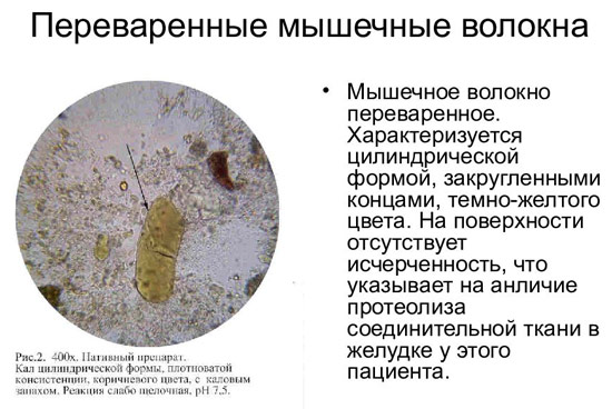 Наличие в кале мышечных волокон В норме волокна с исчерченностью (непереваренные) в кале отсутствуют