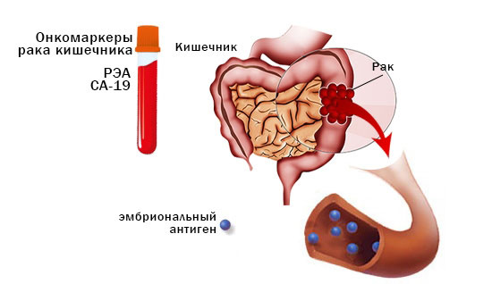Раково-эмбриональный антиген при диагностике рака кишечника