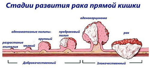 Рак прямой кишки