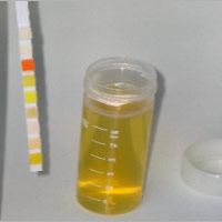 Протеинурия - появление белка в моче