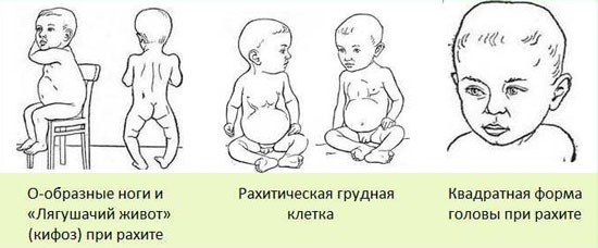 Рахит у детей К чему приводит недостаток кальция у детей