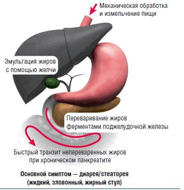 Панкреатическая стеаторея Стеаторея – жирный кал