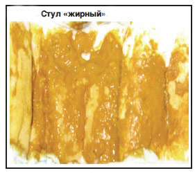Жирный стул Как выглядит жирный кал