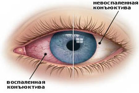 Сравнение здоровой и воспаленной конъюнктивы 1