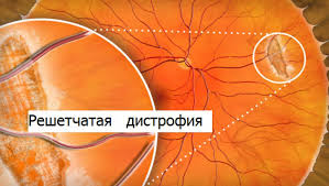 Решетчатая дистрофия
