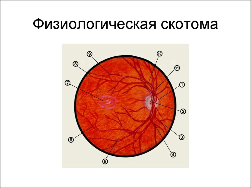 скотома 4